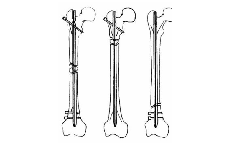 骨科金屬植入物產(chǎn)品注冊(cè)申報(bào)資料關(guān)注點(diǎn)
